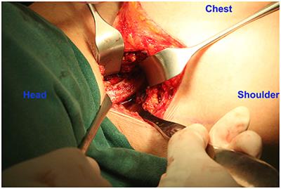 A Novel Approach to First-Rib Resection in Neurogenic Thoracic Outlet Syndrome